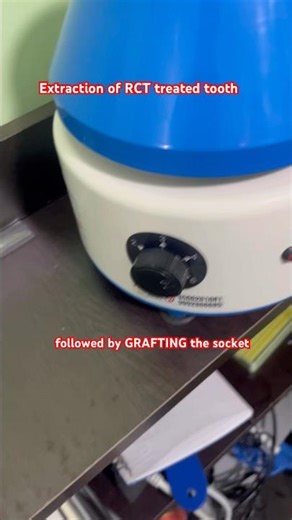Extraction of RCT treated tooth and grafting the socket