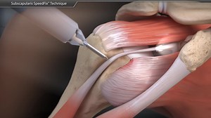 Subscapularis SpeedFix™ Technique