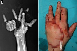 Graphic photos show man's crushed hand is sewn back together after being mangled in recycling machine