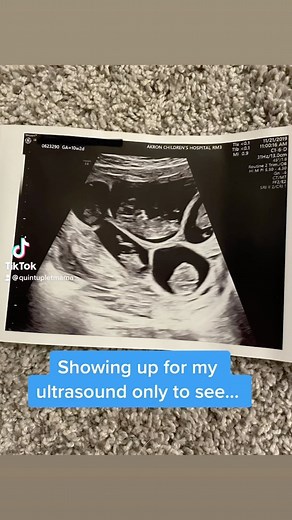 Hannah Merton on Instagram: "Sometimes it still feels like a dream 😂 I wish I could’ve seen that appointment from an outsiders prospective. . . . . . . . . . . . . #quintuplets #multiplepregnancy #highordermultiples #quints #pregnancy #ultrasound #pcos #infertility #firstimemom #reel #reelsinstagram #reels #anotherone #momofmultiples #twinsandmultiples #quintupletsofinstagram"