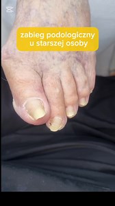 zabieg podologiczny u starszej osoby #obcięciepaznokci #cuttingtoenails #pedicureleczniczy #zabiegpodologiczny #ingrowntoenail #ingrowntoenailremoval #podologo #podologia #podology #podopogotowiewarszawa | Gabinet Podologiczny PodoPogotowie
