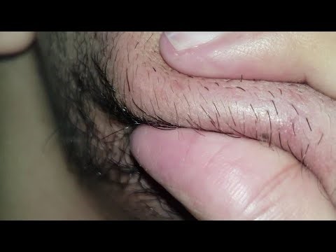 ASMR Relaxing Massage therapy | Hair care Satisfying | Ingrown hair removal | skin care routine