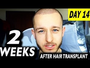 Fue Hair Transplant 2 Weeks (post op) Istanbul, Turkey