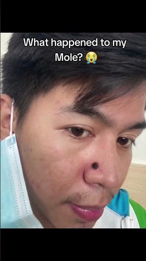 Kasoy Cream - Mole Remover, Warts Remover & Skin Tag Remover by I Love Nature Organics