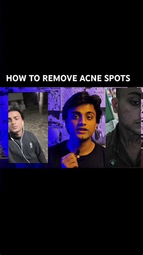 How To Remove Acne Marks At Home Naturally