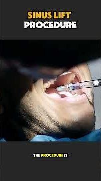 How Sinus Lift Procedure Is Done | Step-by-Step Dental Implant #medicaleducation