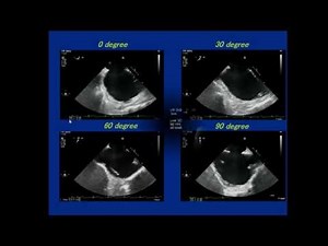 3D-TEE imaging for ASD closure