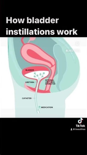 Bladder instillations for recurrent or chronic UTI