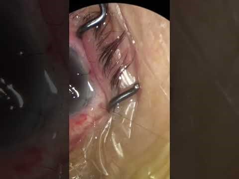 Extra Capsular Cataract Extraction ECCE