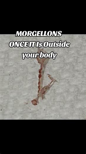 MORGELLONS OUTSIDE THE BODY