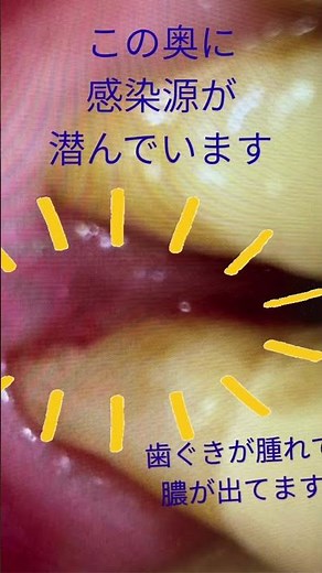 歯ぐきから膿が出る本当の原因｜見えない感染をレーザーで除去