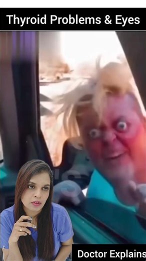 what thyroid can do to eyes #drnalliramya #thyroid #thyroidproblems #thyroidfood #ent #ramicos