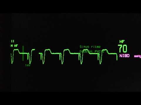 paced ventricular rhythm on an ECG monitor