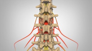 Laminectomy - Patient Animation