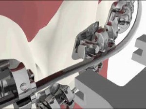 3M SmartClip SL3 Wire Engagement