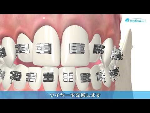 ブラケット矯正とは【金属の装置】｜仕組み、流れ、取り外し方を3D動画でチェック