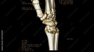 Ct scan 3D rendering image and 2D coronal and sagittal view of wrist joint rotating on the screen. medical footage concept.