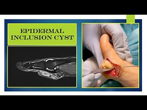 Video - another epidermal inclusion cyst