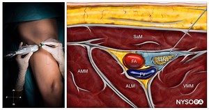 Subsartorial Blocks - NYSORA