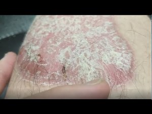 Dead Sea Trip: Pre Treatment Baseline w/bonus "Dry Splits" [Psoriasis]