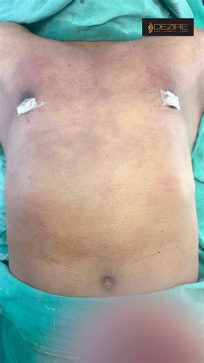 Gynecomastia Surgery