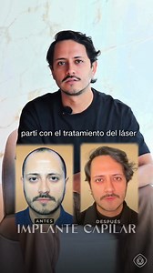 Te compartimos el excelente resultado de Héctor quien después de un implante capilar y un tratamiento complementario con PRP capilar, láser capilar Capillus y tratamiento farmacológico, recuperó su pelo. Confiar en un equipo médico especializado en reparación capilar marcó la diferencia. Si estás pensando en un injerto capilar o en un tratamiento capilar efectivo, agenda tu evaluación sin costo. #ImplanteCapilar #PRPCapilar #LáserCapilar #CaídaDelPelo #ReparaciónCapilar #ClínicaLoArcayaUnity | C