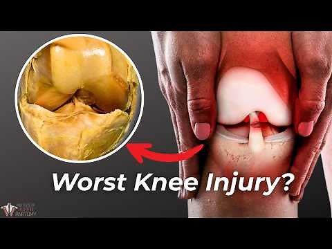 Shocking Look Inside a Torn ACL (Cadaver Dissection Revealed)
