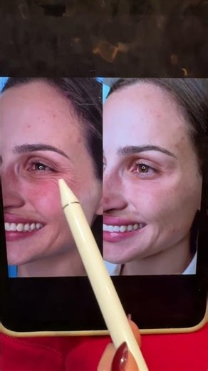 Combatendo a flacidez ao redor dos olhos!