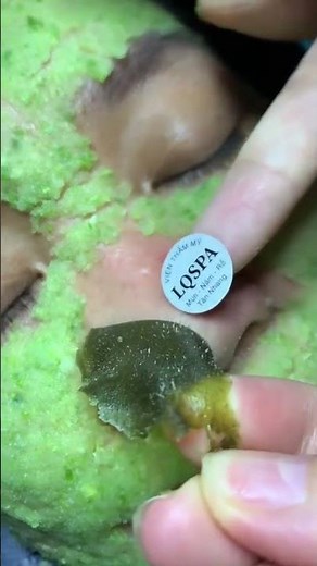 “Blackhead Removal Treatment 😍 | Whiteheads Clean | Satisfying Facial”