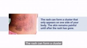 Shingles can be very painful, and it’s important to know the symptoms. Watch this short video to learn more. For more information, visit www.nhsinform.scot/shingles #ShinglesVaccineScot | NHS Grampian | Facebook