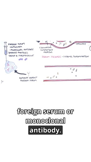 Immunology Insights: Serum Sickness #TypeIIIHypersensitivity #ImmuneComplexes #immunology #meded