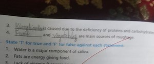 Kwashiorkor is caused due to the deficiency of proteins and car... | Filo