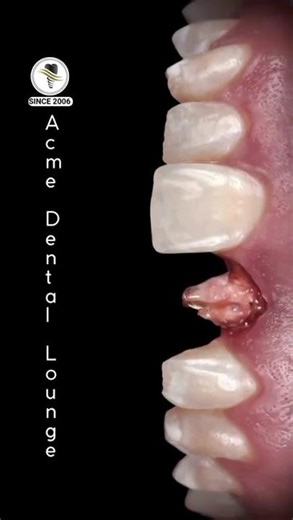 Dental Core Build-up Treatment | Acme Dental Lounge ® | Dentist in Pune