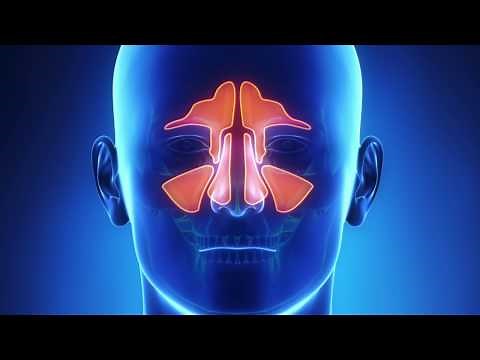 Balloon Sinuplasty Explained - Dr. Ryan M. Kauffman - Northwest ENT
