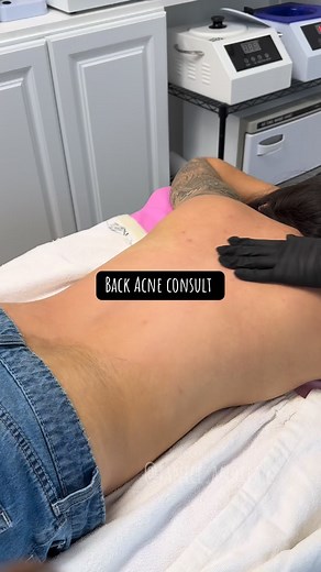 What do you use to help with your back acne ? | Andrea Aesthetics