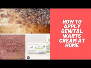 How to treat genital warts at home with warts cream (Imiquimod Cream)