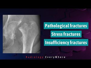 Pathological fracture, stress fracture and insufficiency fractures | Radiology Everywhere