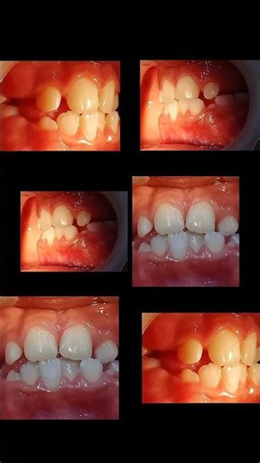 Caso que resolveremos primero con Ortopedia Maxilar y después Ortodoncia 👌#ortodoncia #especialistas