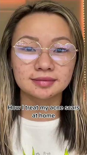 The Most Effective Treatment for Treating Acne Scars At Home #acnescars