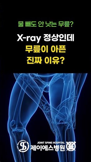 X-ray 정상인데 무릎이 아픈 이유? 카티스템 치료가 필요한 순간?