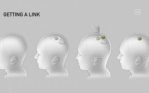 马斯克发布“脑机接口”设备：硬币大小 可植入猪脑实时读取信息