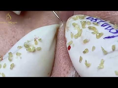 Loan Nguyen Acne Treatment speacal