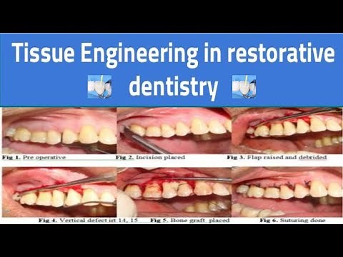 Tissue Engineering in Restorative Dentistry
