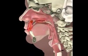Abcès dentaire : causes, symptômes et traitement | Tout savoir sur la Médecine