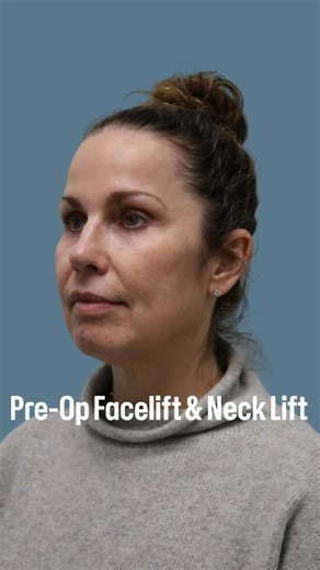 Dr. Sarah Novis on Instagram: "Pre-Op Interview: Preparing for a Deep Plane Facelift and Neck Lift with Dimple Preservation! Before surgery, we take the time to thoroughly discuss the patient’s goals and create a personalized plan. For this lovely patient—ensuring her results look refreshed, youthful, and authentically her. Stay tuned as we walk you through her journey to a beautifully balanced transformation! Why patients choose Dr. Novis for their facelift and necklift: - No need for general a
