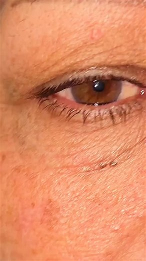 Benign eyelid myokymia is a very common and harmless condition that most people experience at some point in their life. It usually presents as a brief, involuntary twitching of the lower eyelid that comes and goes on its own. Although it can feel annoying or worrying, it does not affect vision and is not a sign of a serious eye or neurological disease. The twitching is caused by small, repetitive contractions of the muscle that closes the eyelid. Triggers often include stress, fatigue, lack of s