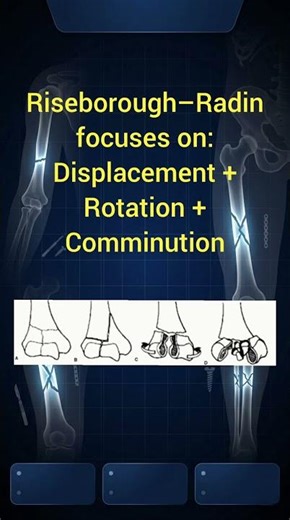 Riseborough & Radin Explained in 30 Seconds #orthopaedics #fractureclassification