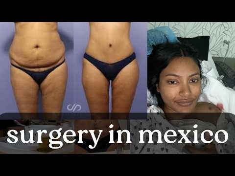 My mommy makover experience in Tijuana Mexico! | tummy tuck, bbl, breast augmentation, lipo 360
