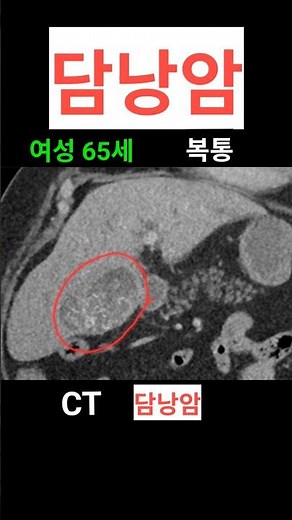 담낭암 CT 진단