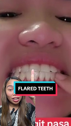 Teeth Restoration and Midline Correction: How to Deal with Flared Teeth